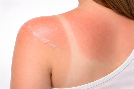 Photorealistic 3D medical-grade close-up of a sunburned shoulder and upper arm (cropped, no face): natural mild-to-moderate erythema with realistic peeling sheets of epidermis, subtle dryness at edges