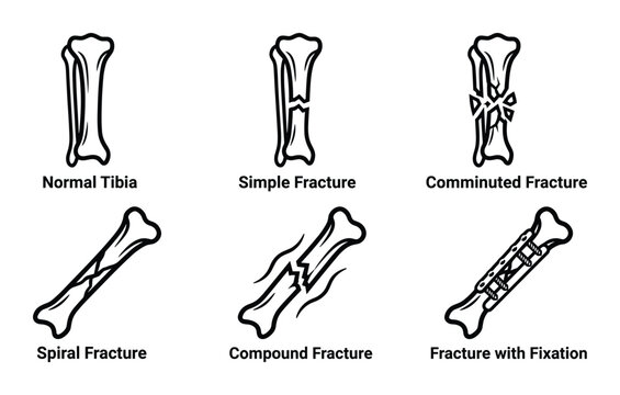 Types of Tibia Fractures Diagram: Normal, Simple, Comminuted, Spiral, Compound, Fracture with Fixation