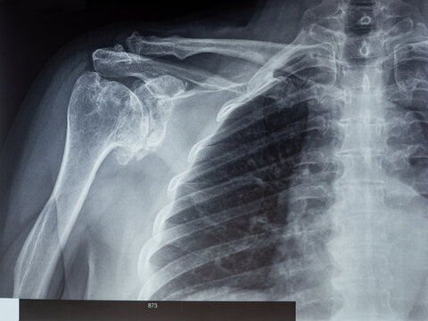 Detailed X-ray of the shoulder and upper chest. Diagnostic examination of the internal skeleton.