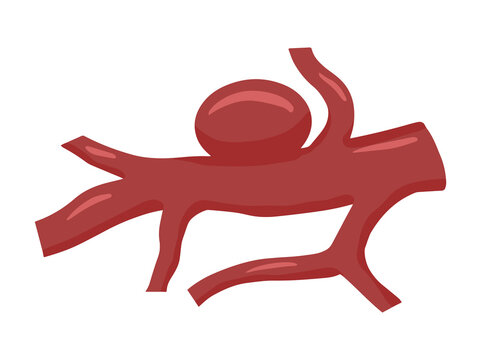 Saccular Aneurysm Blood Vessel Illustration