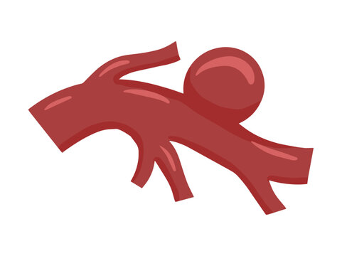 Saccular Aneurysm Blood Vessel
