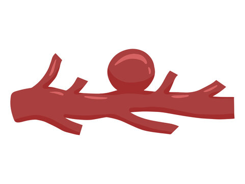 Saccular Aneurysm in Blood Vessel
