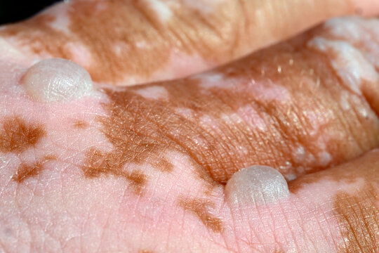 Brandblasen, Verbrennungen durch Kontakt mit Riesen-B&auml;renklau (Heracleum mantegazzianum)