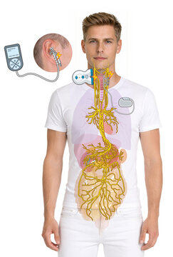 Vagus Nerve Stimulation with Implant and Auricular Electrode