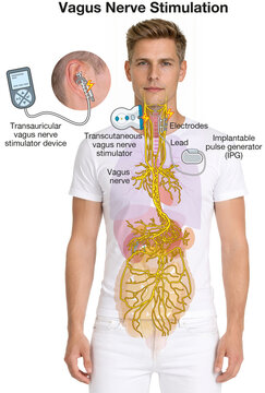 Vagus Nerve Stimulation with Implant and Auricular Electrode