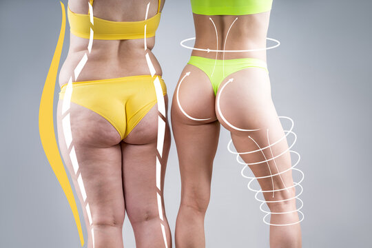 Buttocks with cellulite vs smooth skin, slim and overweight woman body with love handles comparison, before and after