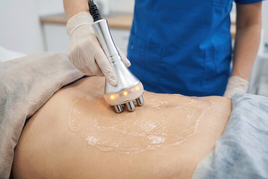 Cosmetic radiofrequency treatment on female abdomen