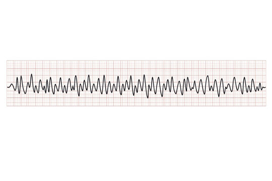 Ventricular fibrillation ekg trace showing irregular cardiac rhythm on a grid, representing a critical heart condition