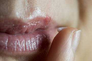 Fototapeta premium Detail of a finger with medicated cream about to treat a contagious cold sore blister on the lip.