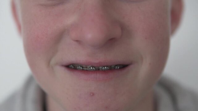 Close-up of the mouths of a light neck with braces on the upper teeth. Bad and uneven teeth with pigmentation