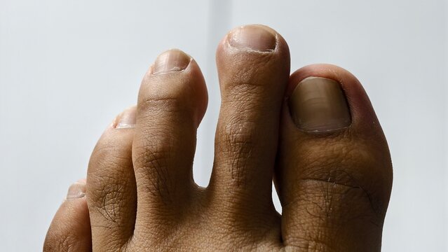 Close-up view of human toes featuring various nail shapes and skin textures against a neutral background, highlighting anatomical details of the foot for medical or health-related imagery.