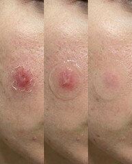 Naklejka premium Skin care treatment steps for facial blemish on cheek