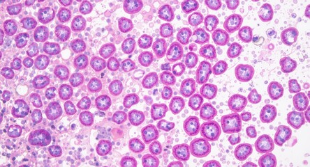 Examination of female cervical adenocarcinoma cells revealing feathering morphology in malignant tissue sample