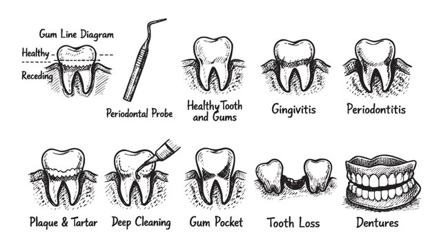 A graphic illustration showcases the stages of periodontal disease, including healthy gums, gingivitis, periodontitis, plaque, tartar, deep cleaning, gum pockets, tooth loss and dentures.