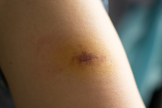 Bruise injury found on the female arm