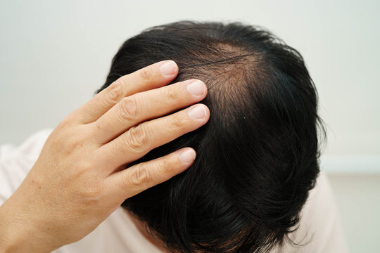 Bald in the middle head and begin no loss hair glabrous of mature man.