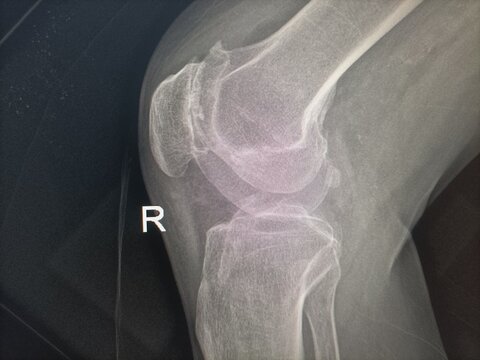 right knee x-ray lateral view