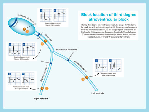 Third degree atrioventricular block can occur in the atrioventricular node, His bundle, and bundle branches, and only the escape rhythm from below the block layer can excite the ventricle.
