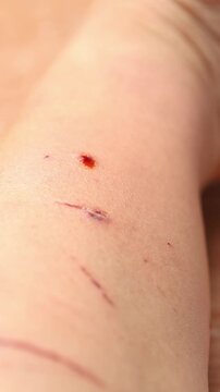 Use a cotton swab dipped in red povidone iodine to apply to the wound on the human skin. Close-up shot