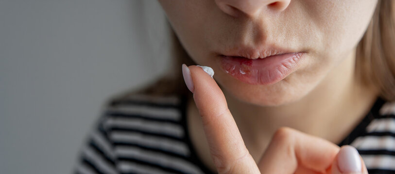 Woman applying medical cream on herpes sore on her lip - virus treatment concept.