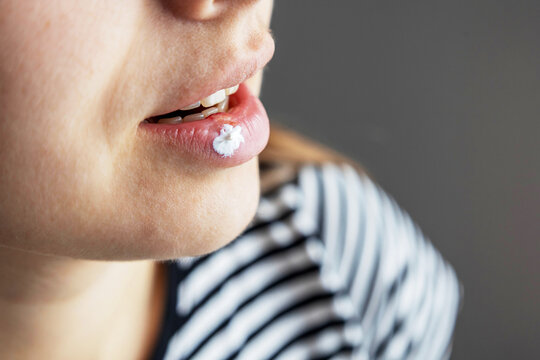 Close-up of white medical cream applied on herpes sore on woman's lower lip.