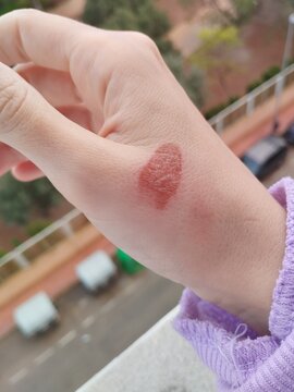 A close-up of a hand showing a burn on the skin. The burn appears red and swollen, indicating a second-degree burn. The hand is pale and has a light purple sweater sleeve.
