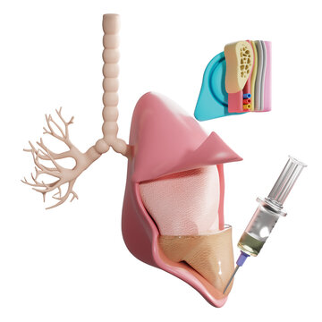 Pleura layers and pleural effusion with thoracentesis syringe. 3D illustration.