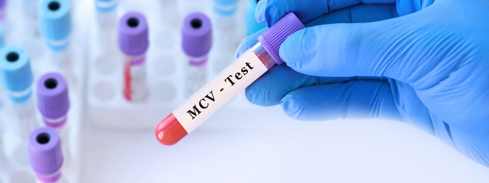 Doctor holding blood sample tube with MCV test, mean corpuscular volume analysis explaining red blood cell size for anemia detection, blood disorders diagnosis and complete blood count interpretation