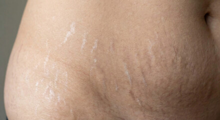 Fototapeta premium Close-up of skin with stretch marks on abdomen 