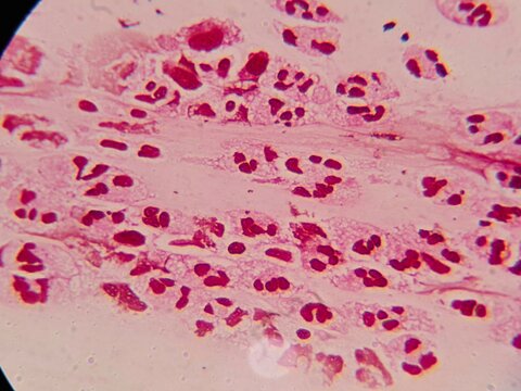 Microscopic view of a Gram-stained secretion smear showing numerous polymorphonuclear leukocytes (neutrophils). The cells display characteristic lobulated nuclei. This high-magnification clinical imag