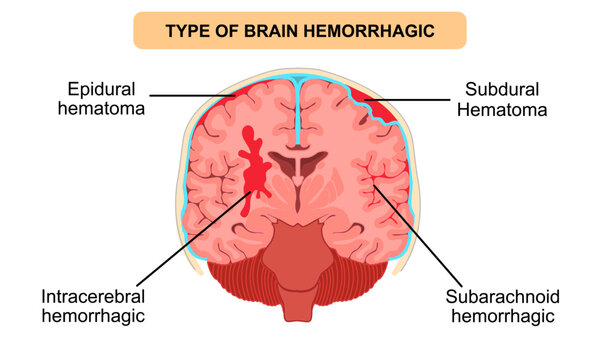 Types of brain hemorrhage. epidural hematoma, subdural hematoma, intracerebral, subarachnoid. Human brain anatomy. Vector illustration for medical, clinic, poster, and education.
