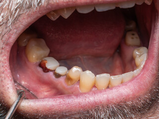 Freshly filled and prepared mandibular 5th and 6th teeth for metal-ceramic prosthetic crowns