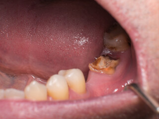 Obraz premium Severely destroyed mandibular second molar between a missing first molar and a decayed third molar
