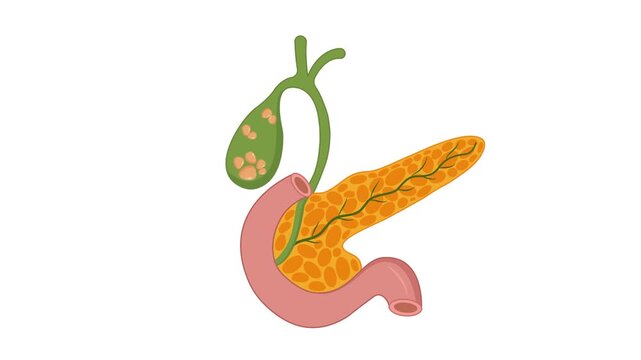 gallstones formation in gallbladder medical animation