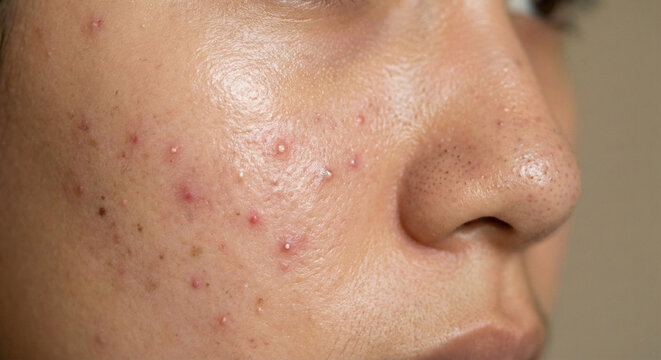 Extreme close-up of oily skin texture with active whiteheads, blackheads, and redness on the nose and cheek.