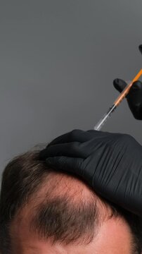 Doctor in black gloves performing scalp injection for hair loss treatment on man with thinning hair, concept of alopecia therapy and trichology procedure. Vertical video.