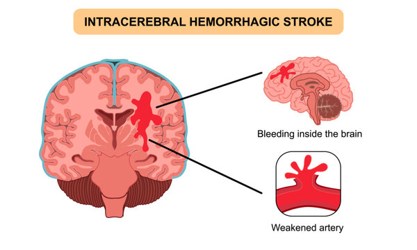 Brain stroke hemorrhagic Intracerebral. Arteriosclerosis, infarct, ischemia, thrombosis disease. Cholesterol in human blood vessels. Medical poster vector illustration.