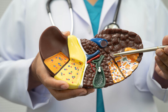 Cirrhosis, Liver cancer, fatty liver, Asian doctor with liver human model.