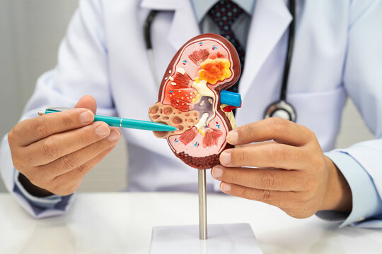Chronic kidney disease, doctor with model for treatment urinary system, urology, Estimated glomerular filtration rate eGFR.