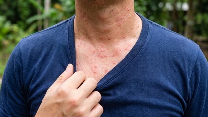 Adult white man chest with red rash and itching, close view of skin irritation outdoors, healthcare and allergy concern, summer heat discomfort and sensitive skin
