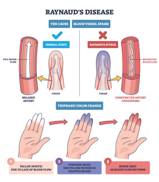 Raynauds phenomenon diagram shows finger artery spasm and triphasic hand color change, key objects, hand, finger, artery. Outline diagram