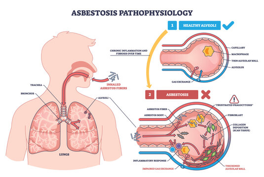 Asbestosis pathophysiology, inhaled asbestos fibers trigger macrophage injury and collagen scarring in alveoli, impairing gas exchange, key objects, lungs, alveoli, fibers. Outline diagram