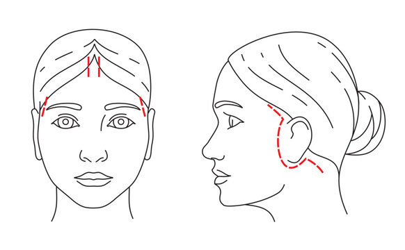 Illustrations of Facelift zones