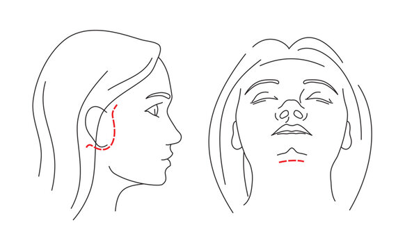 Illustrations of Facelift zones