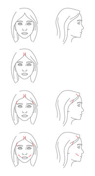 Illustrations of Facelift zones