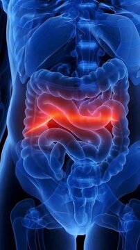 3D medical animation of an inguinal hernia bulge