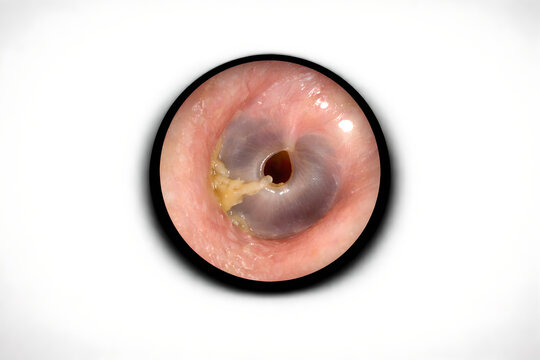 Photorealistic 3D medical-grade otoscopic view showing mild otorrhea consistent with chronic otitis media: small amount of yellowish mucoid discharge thinly coating part of the ear canal wall