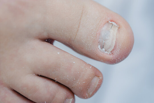 Close-up of big toe with fungal infection and nail damage after sealing with gel polish titanium bracket