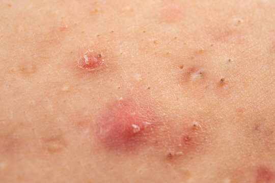 Skin problem background with infected bumps and acne. Macro shot of skin irritation with acne. Acne on skin closeup photo. Detailed skin with acne.