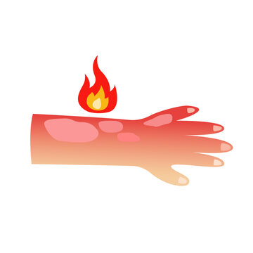 Burned skin. vector illustration design